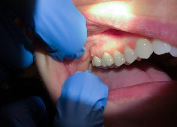 Urgent Tooth Repair in VA